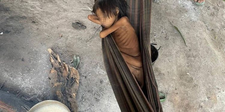 Criança Yanomami com desnutrição e malária, na aldeia Maimasi.
Foto: Divulgação Criança Yanomami com desnutrição e malária, na aldeia Maimasi.
Foto: Divulgação