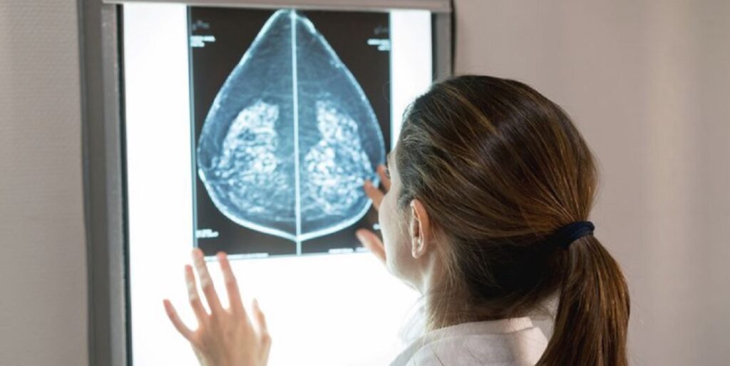 Mamografias no SUS em pacientes com menos de 50 anos representam 30% do total, equivalente a mais de 1 milhão em 2024. Foto: GettyImages