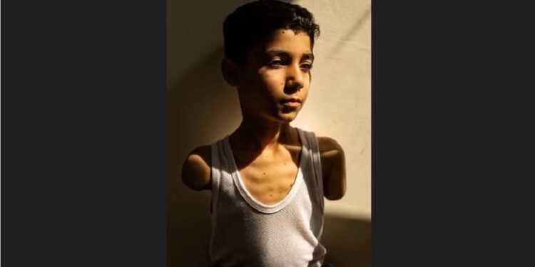 Bloqueio à ajuda médica e destruição de hospitais tornam amputações sentenças de sofrimento permanente. Foto: Samar Abu Elouf Bloqueio à ajuda médica e destruição de hospitais tornam amputações sentenças de sofrimento permanente. Foto: Samar Abu Elouf